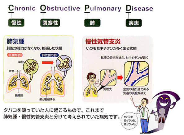 肺気腫や慢性気管支炎