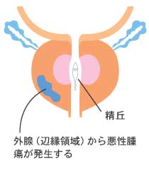 前立腺がん