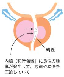 前立腺肥大症