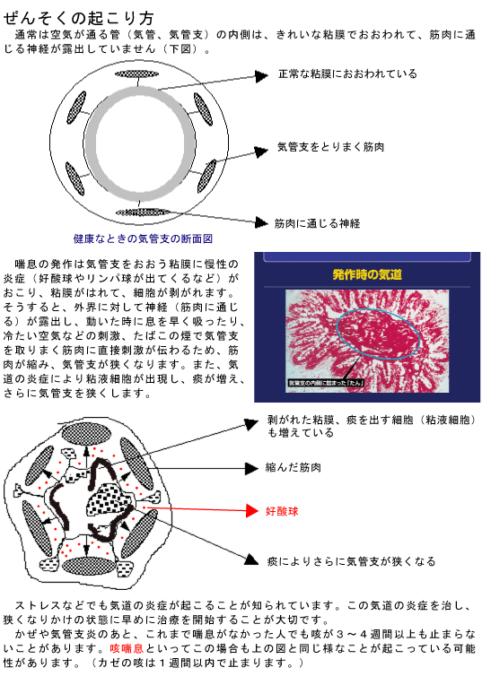 ぜんそくの起こり方