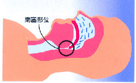 無呼吸の状態