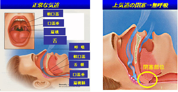 睡眠時無呼吸症候群の原因