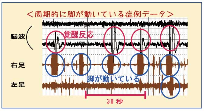 周期的に脚が動いている症例データ